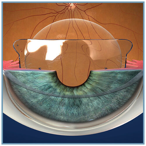 Illustration d'un implant phaque ICL positionné dans l'œil devant l'iris