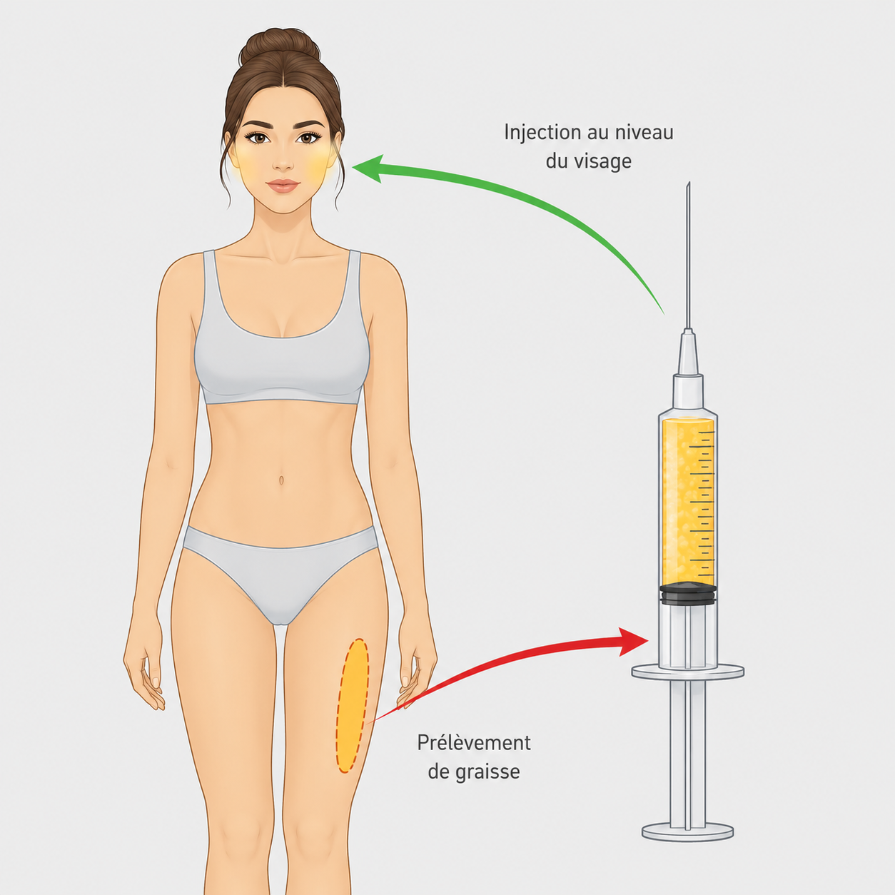 Schéma du lipofilling : prélèvement de graisse puis réinjection au niveau du visage